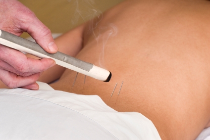 Moxibustion on back