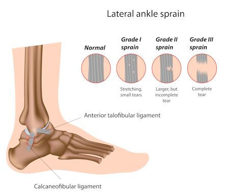 Sports Injury Treatment